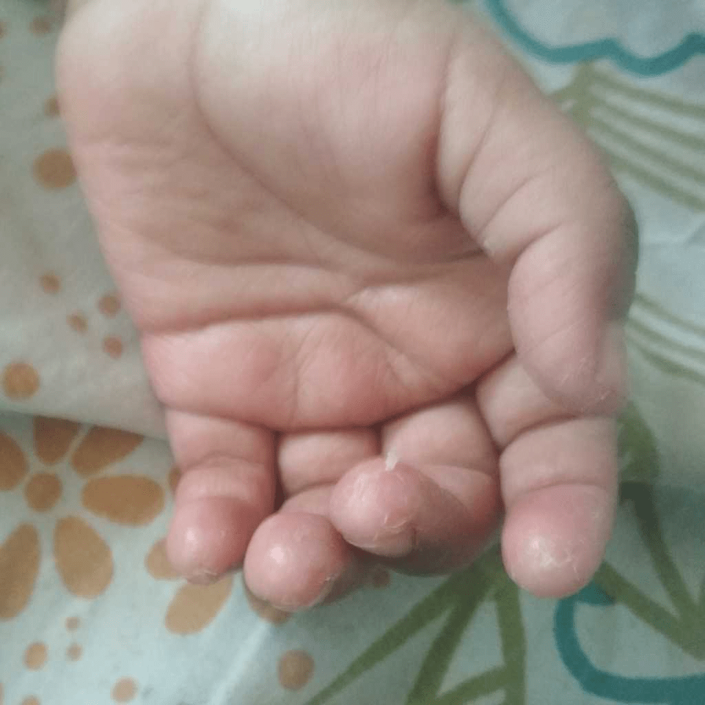 paediatrician palm skin peeling, irritation & dry. FirstCry Parenting