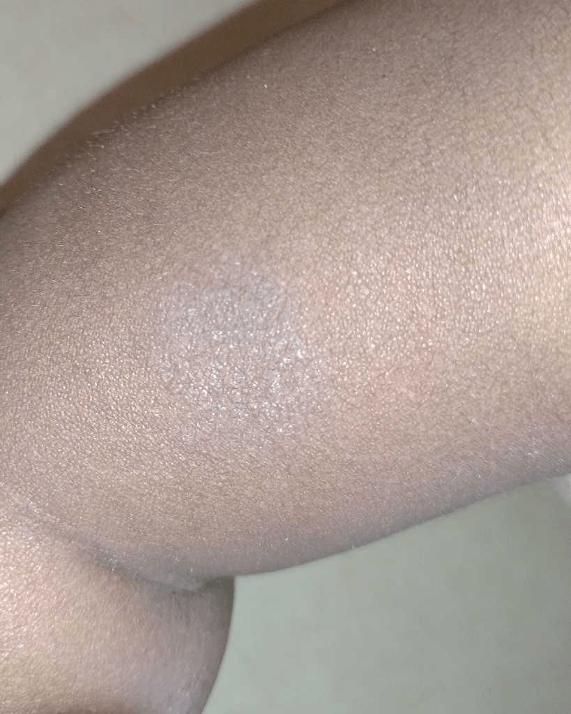 6.5 months old baby has developed Ringworm on his right hand. which cream or lotion can be