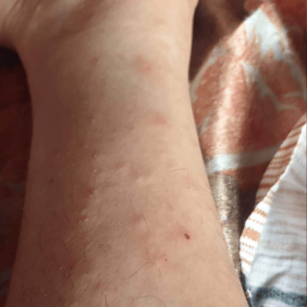 pregnancycare I have itching in between fingers in both hands and legs