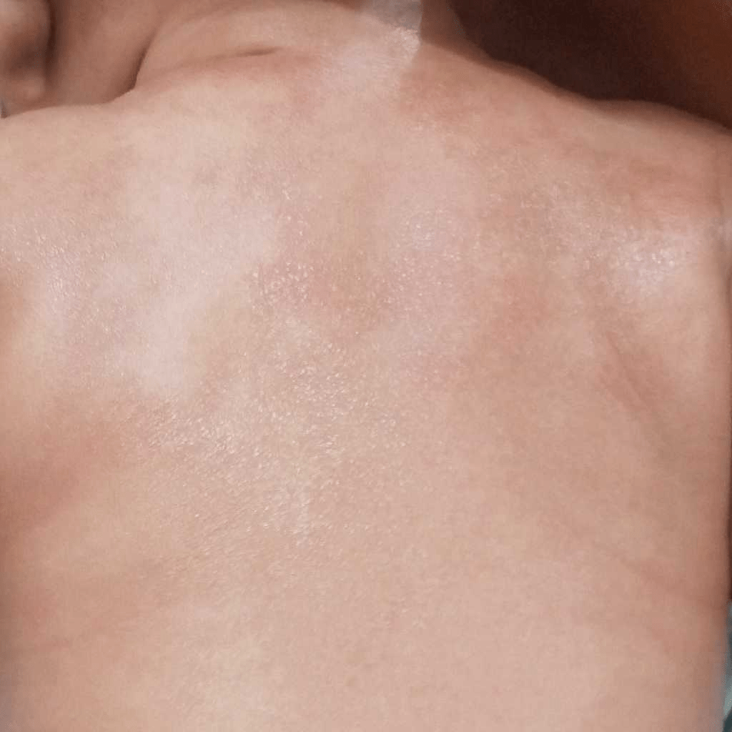 AskTheExpert... How to cure rashes on Hips of 5 Month Baby? FirstCry