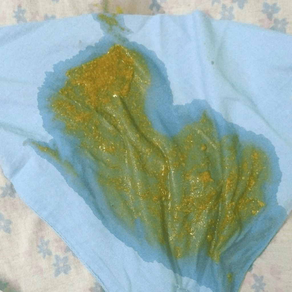 AskTheExpert my 3 month baby have watery and seed like stool after