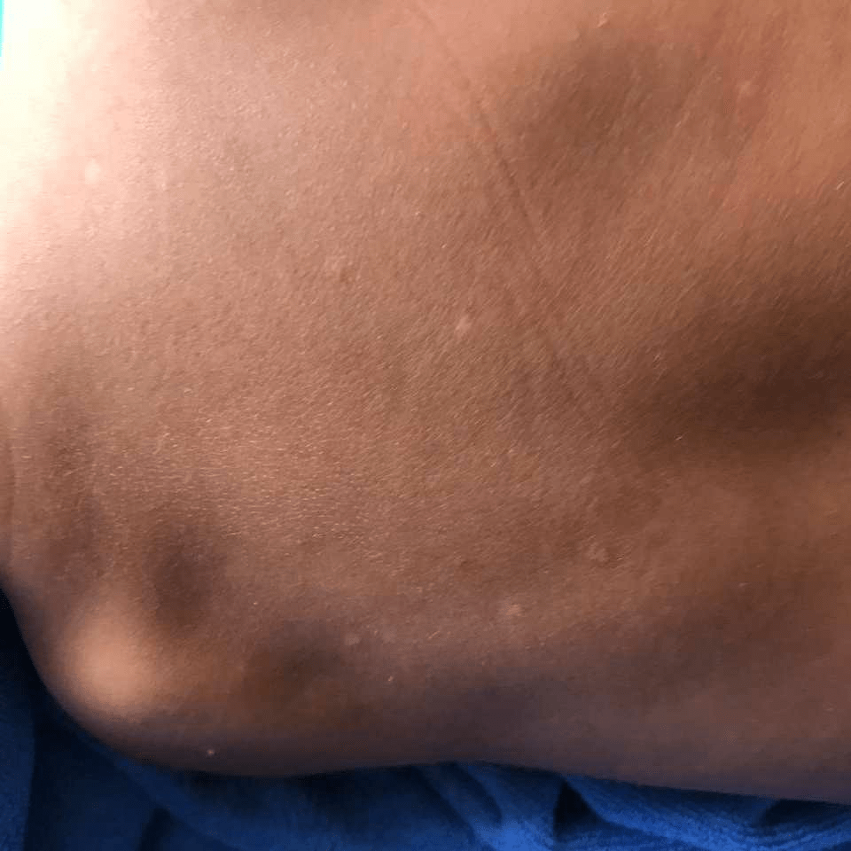 my daughter had rash like white patches under the neck and