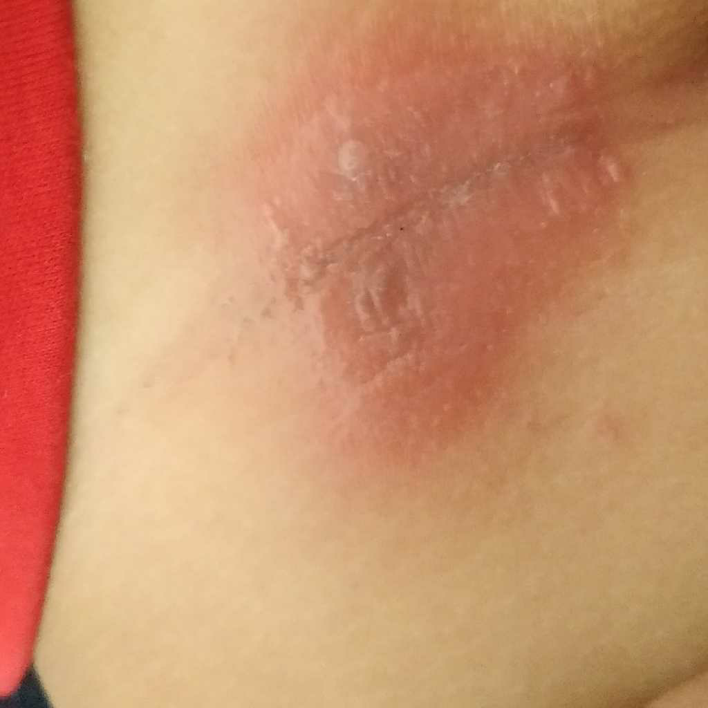 my 5 month baby has got fungal infection on his inner