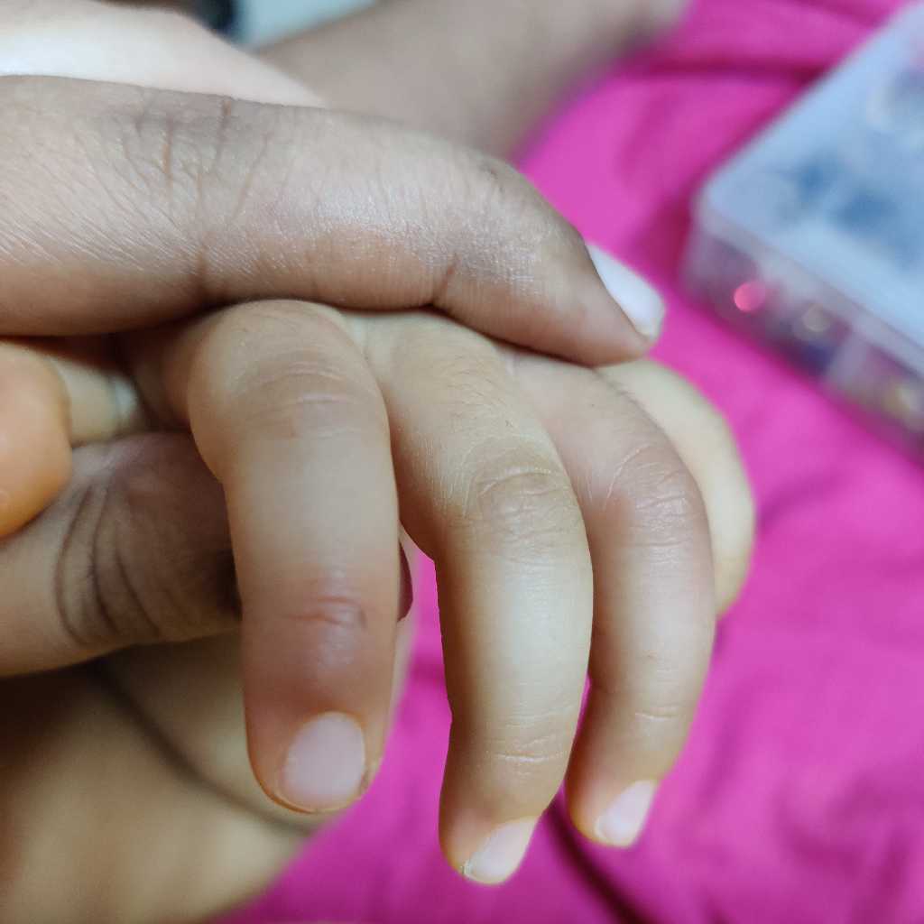 my baby got a boil on her finger ..n it's turned red FirstCry Parenting