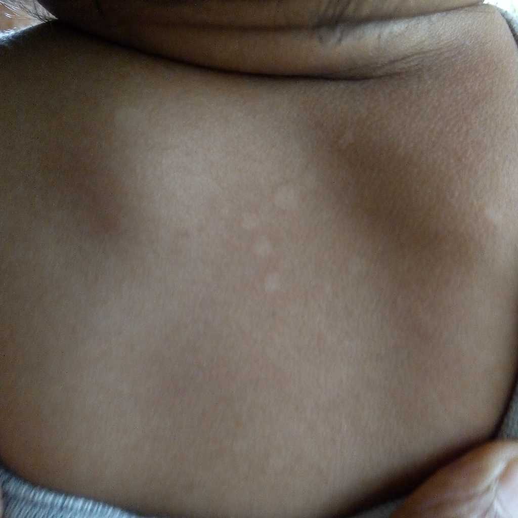 My 9 Month Old Baby Develop Some White Small Spot On Back(Below Neck). – Firstcry Parenting