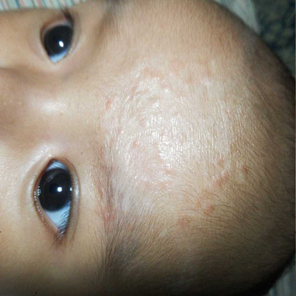 is it a rash or ringworm? FirstCry Parenting