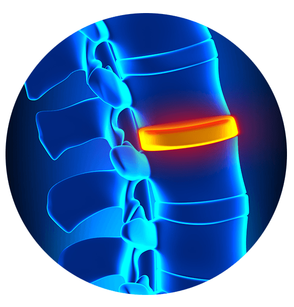 Back Pain Stem Cells Front Range Regenerative Medicine
