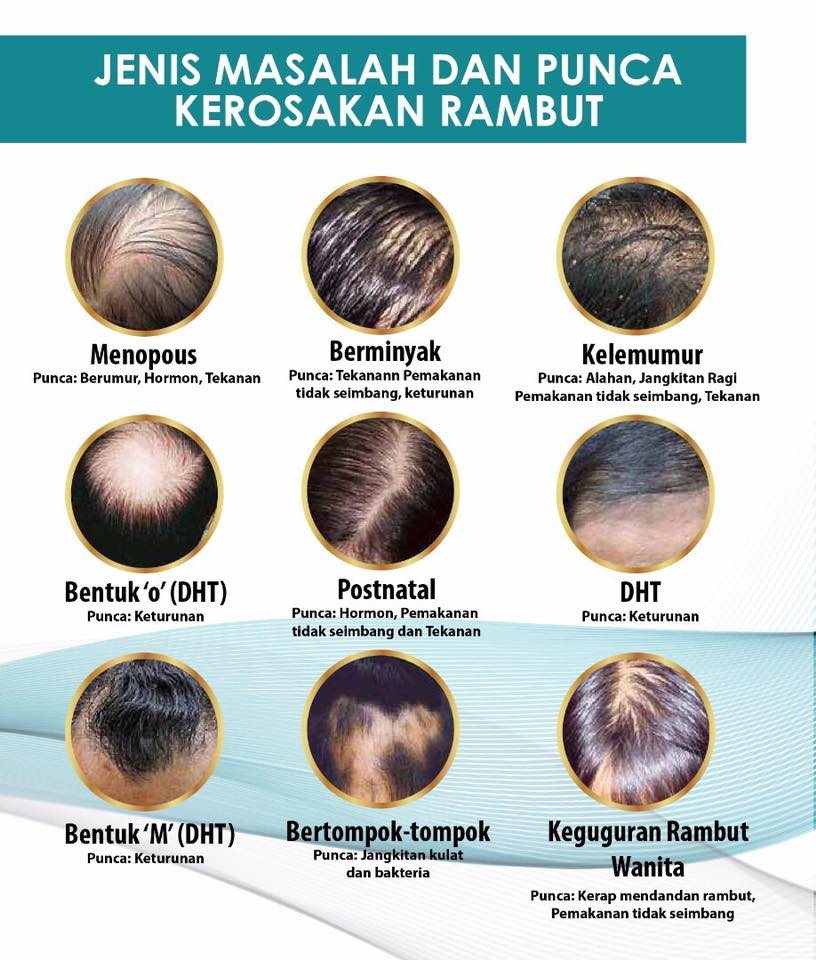 DAPATKAN PERTUMBUHAN RAMBUT SECARA SEMULAJADI DIJAMIN SELAMAT BUAT