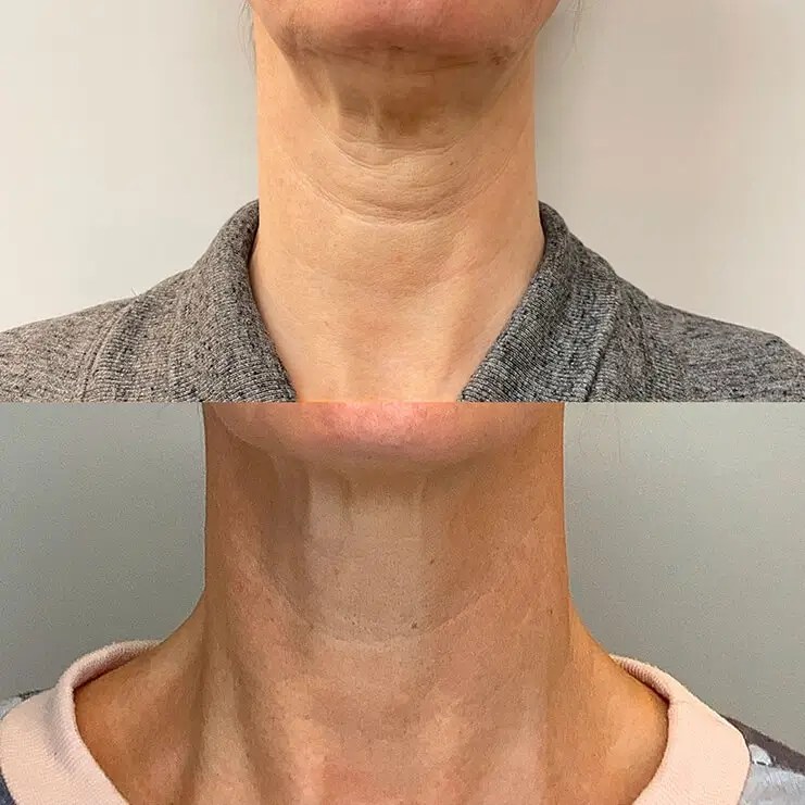 Plasma Pen Forever Young Laser & Skin Center, Wellesley, MA(09)