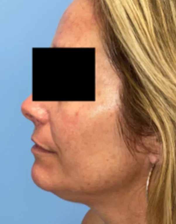 Sofwave™ Forever Young Laser & Skin Center, Wellesley, MA