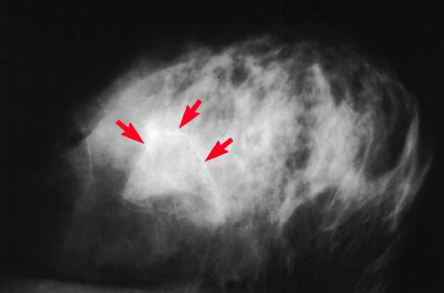 What Breast Calcifications Mean on Your Mammogram What Breast Calcifications Mean on Your Mammogram