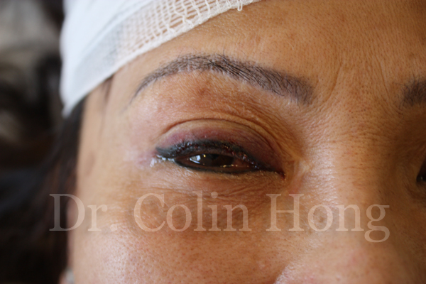 EYELASHES SURGERY