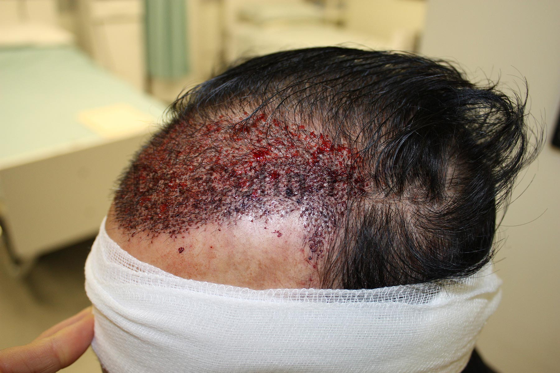 Hair Transplant Before And After FUE Before and After Photos FUE