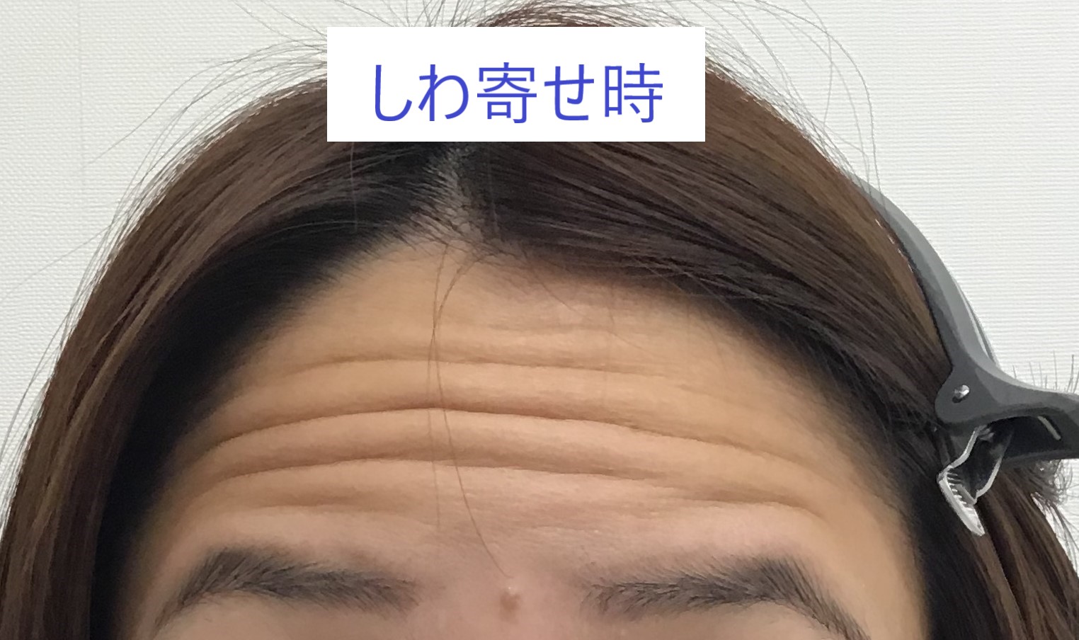 最高のコレクション おでこシワ 287010