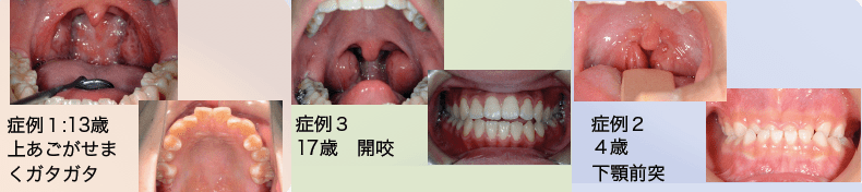 ～舌小帯切除術と扁桃摘出術～ 横浜市の矯正専門歯科｜福増矯正歯科