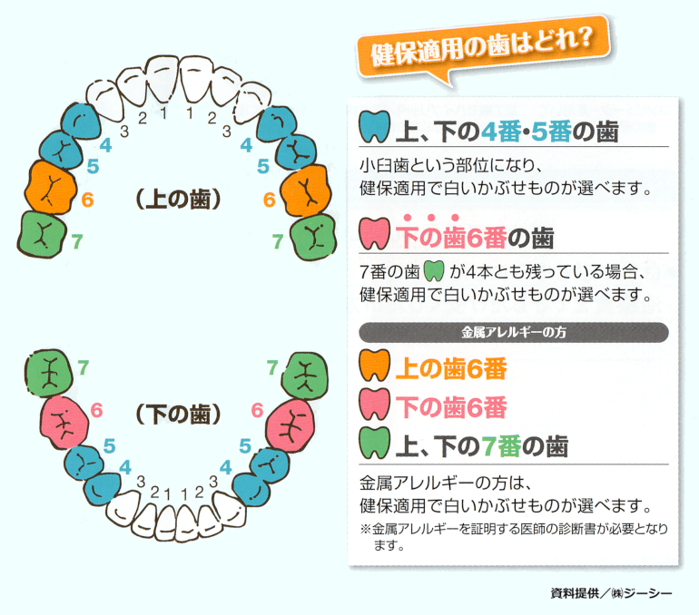 CAD/CAM冠 小田急相模原の歯科医院（歯医者）｜ふくの歯科・矯正歯科｜生涯自分の歯で過ごすための予防歯科｜MI治療で、削らない・抜か