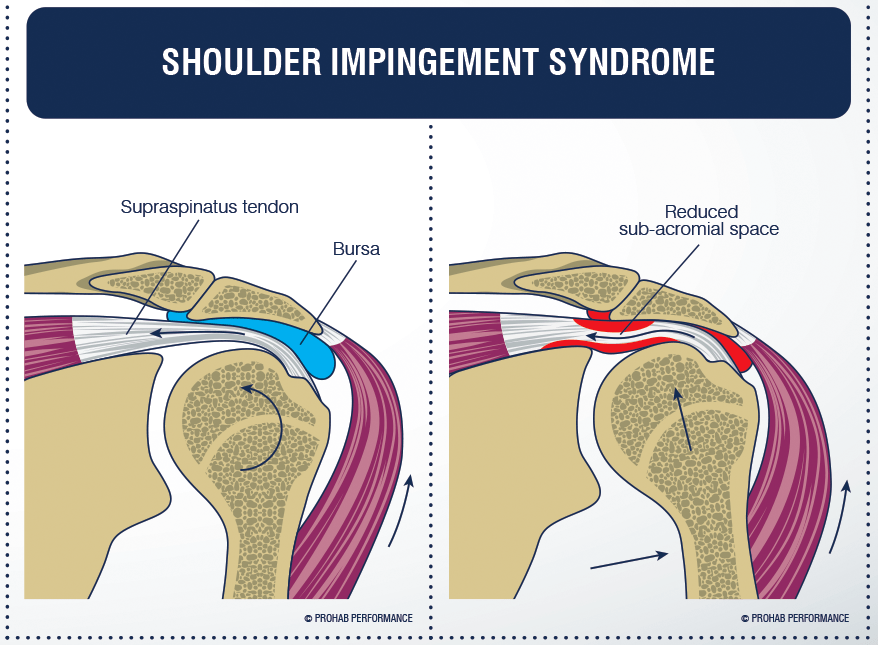Shoulder Impingement Syndrome Full Function Rehab