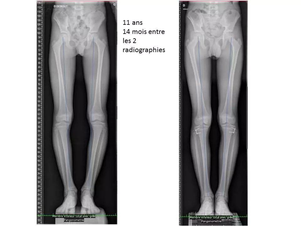 Genoux en x, jambes arquées, pieds plats... Votre enfant doitil se
