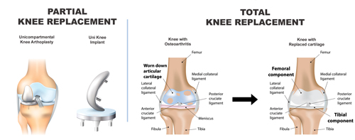 Knee replacement surgery: Cost, recovery time and pain