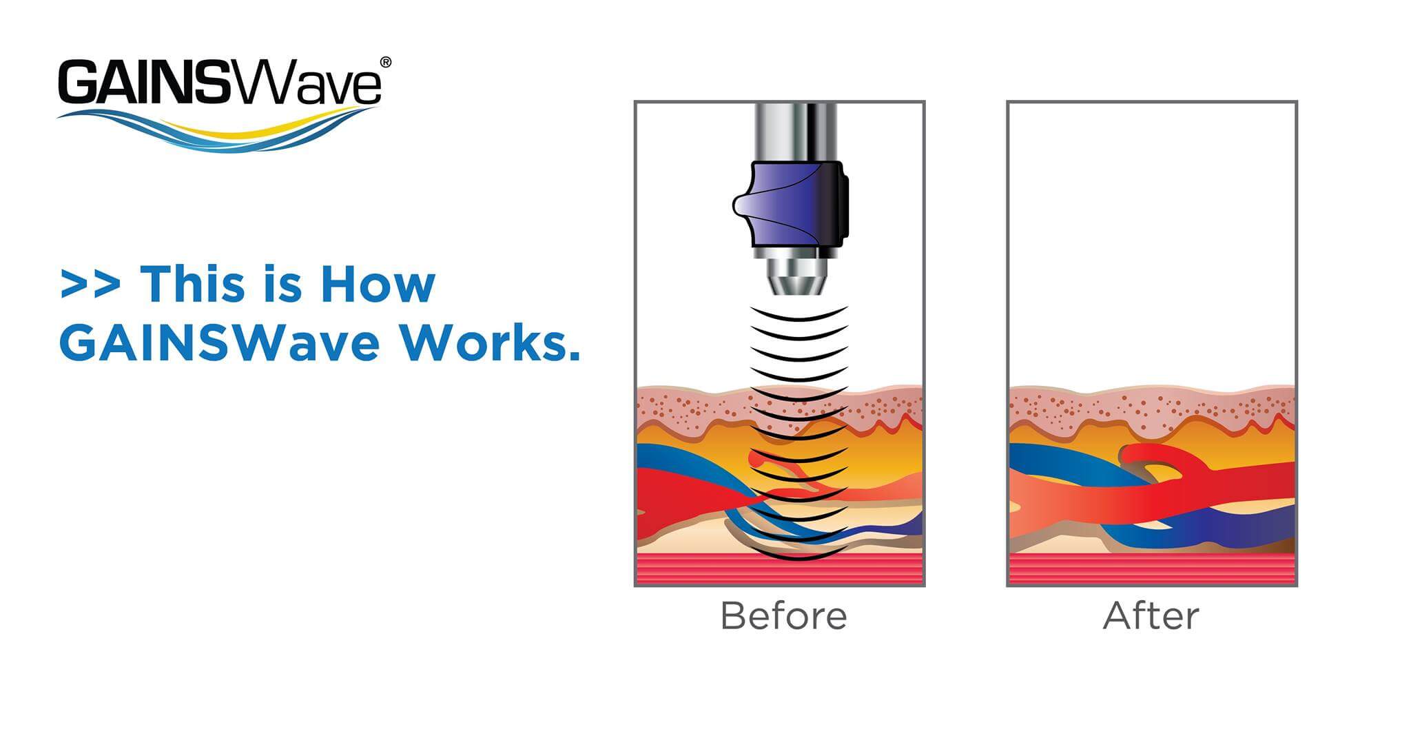 MAXIM Highlights GAINSWave as an Effective ED Treatment GAINSWave