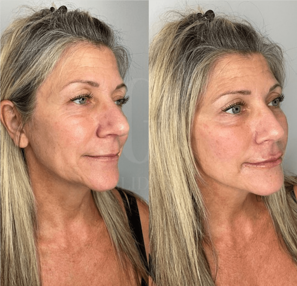 PDO Thread Lift Near Me Facial Threading West Palm Beach