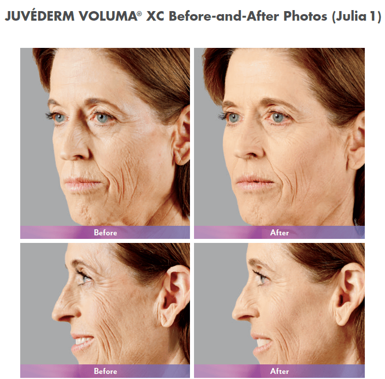 Juvederm Voluma® XC Filler Dermatologist Dr. Gergana