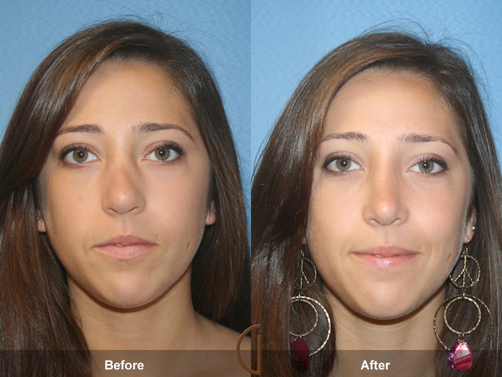 What to Expect Before and After Nose Surgery Sadati, MD