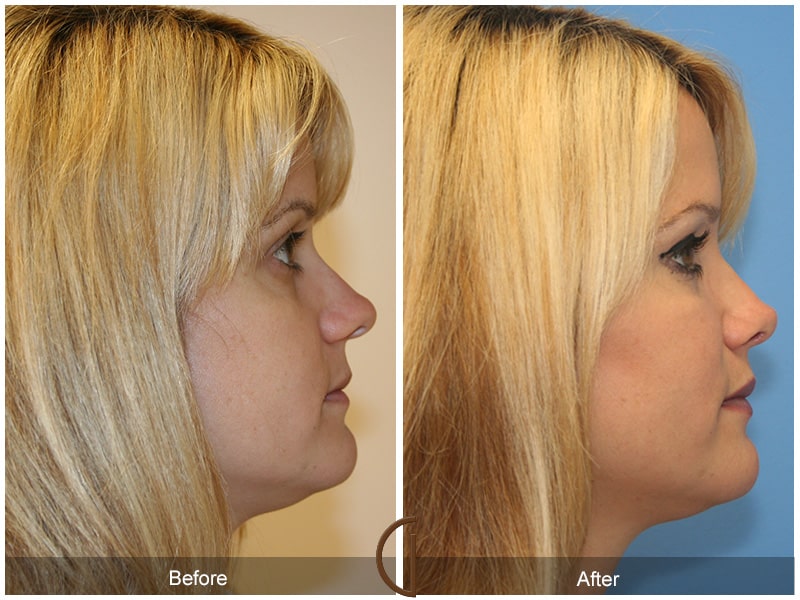Rhinoplasty Nose Surgery Beverly Hills CA Before After Photo 9