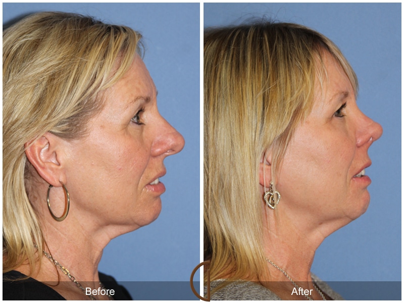 Rhinoplasty Nose Surgery Las Flores CA Before After Photo 103