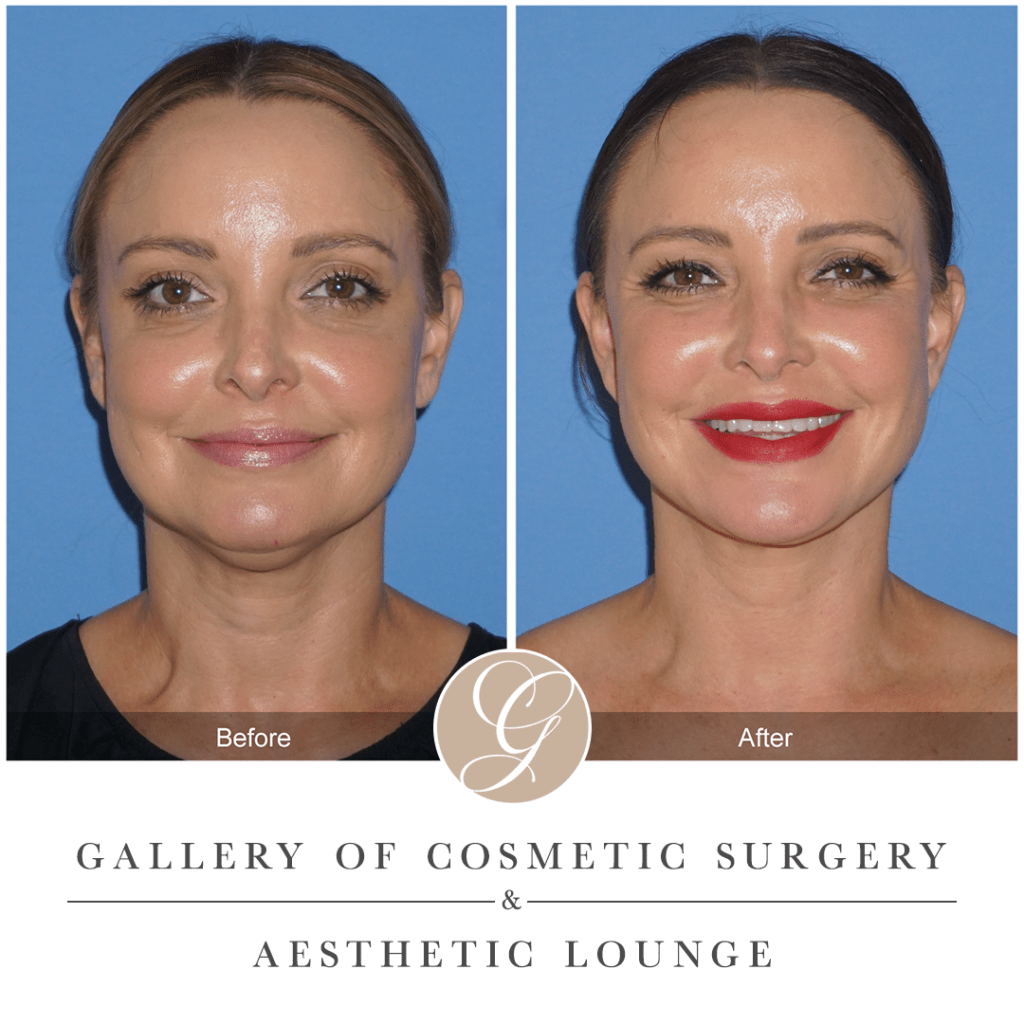 What is Buccal Fat Removal? Sadati, MD