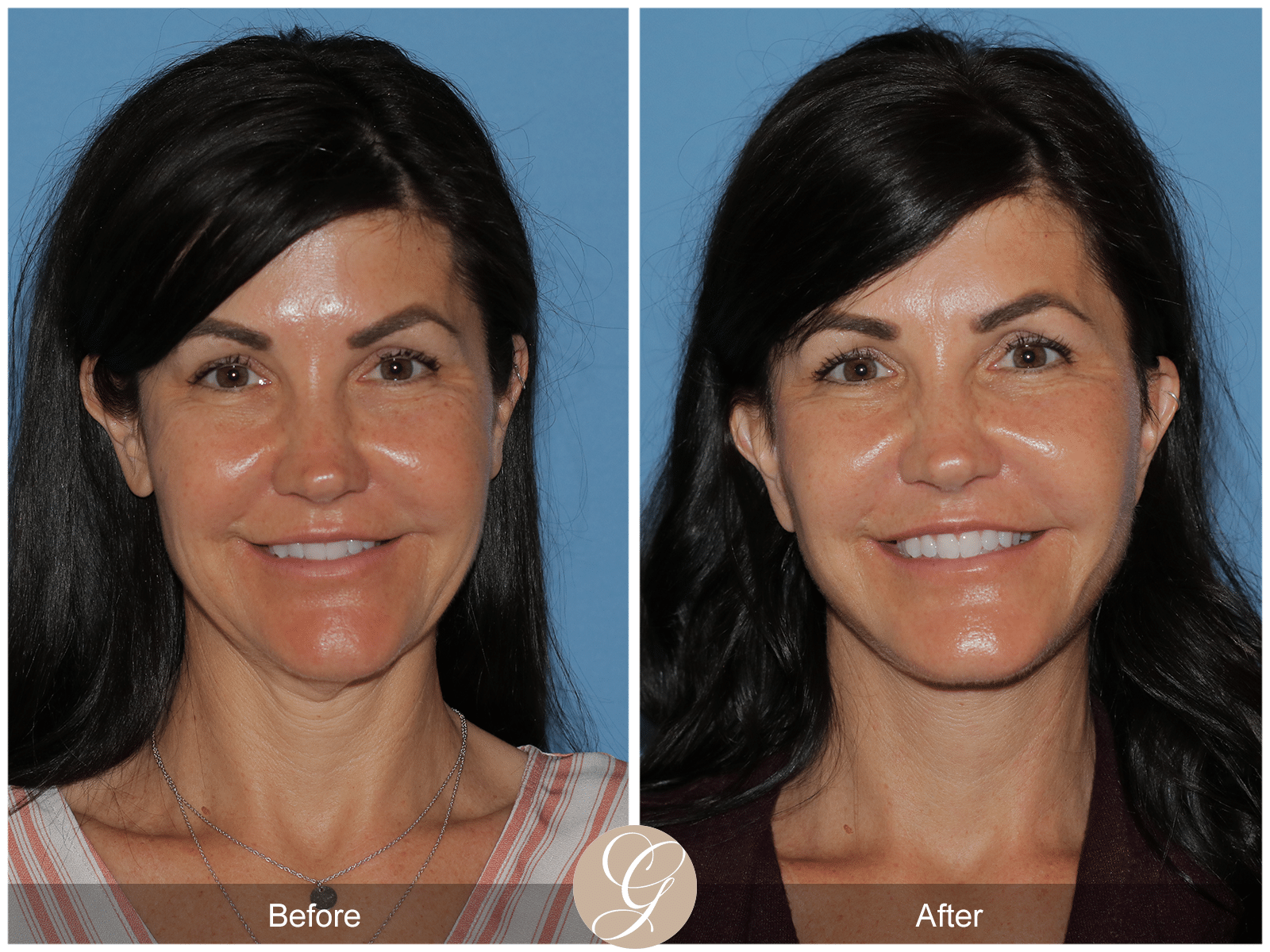 Lower Facelift and Deep Plane Necklift Case 1 Before After Photos Orange County