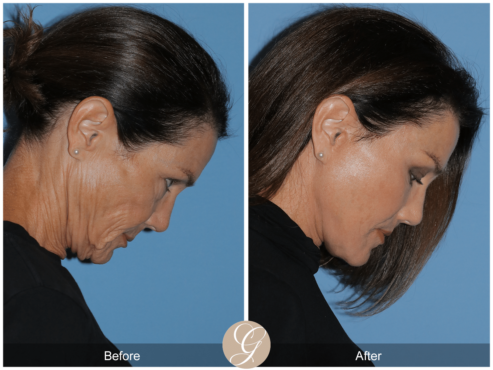 How the Vertical Facelift is Revolutionizing Facial Rejuvenation