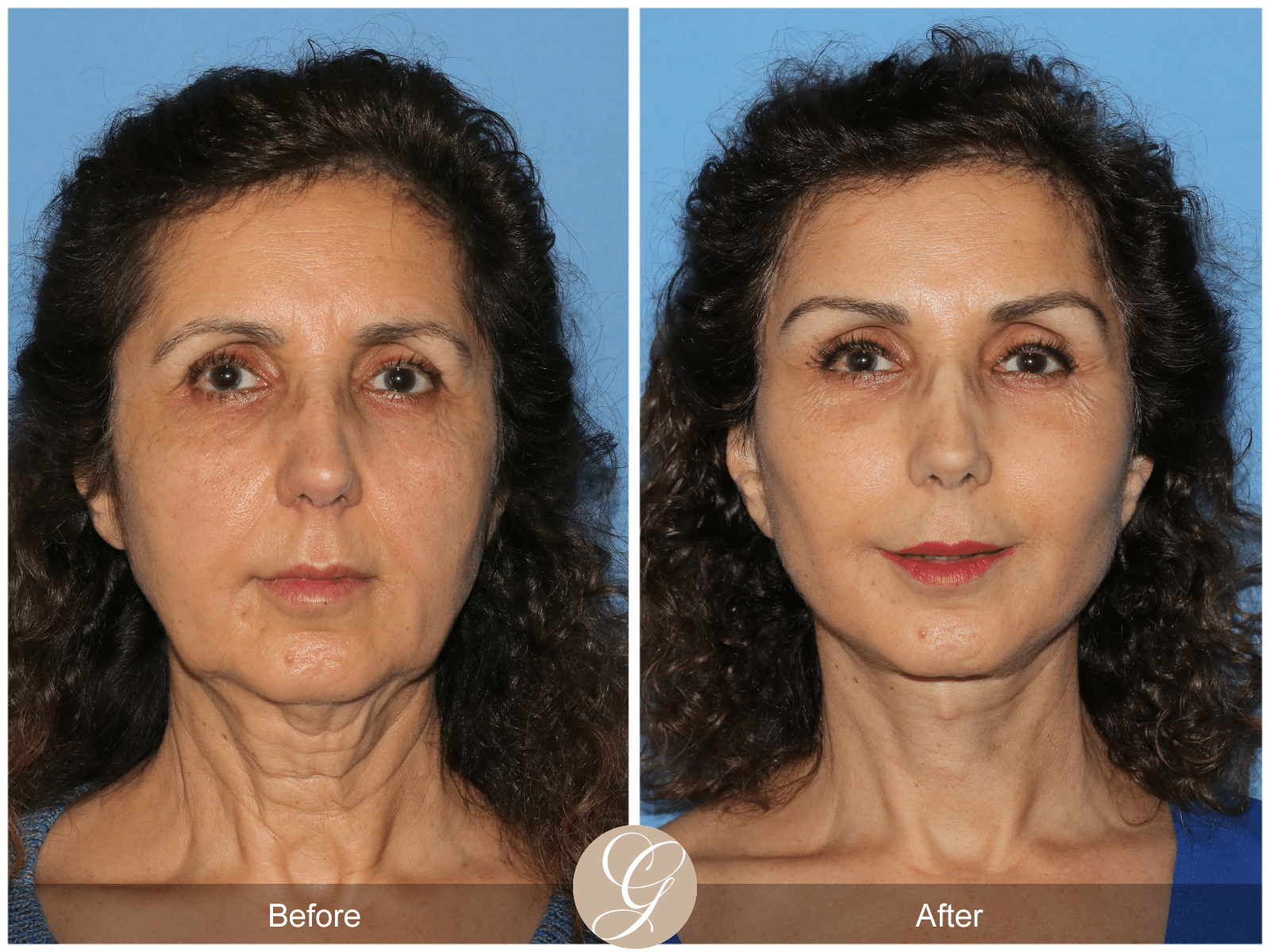 Vertical Facelift Case 3 Before After Photos Orange County