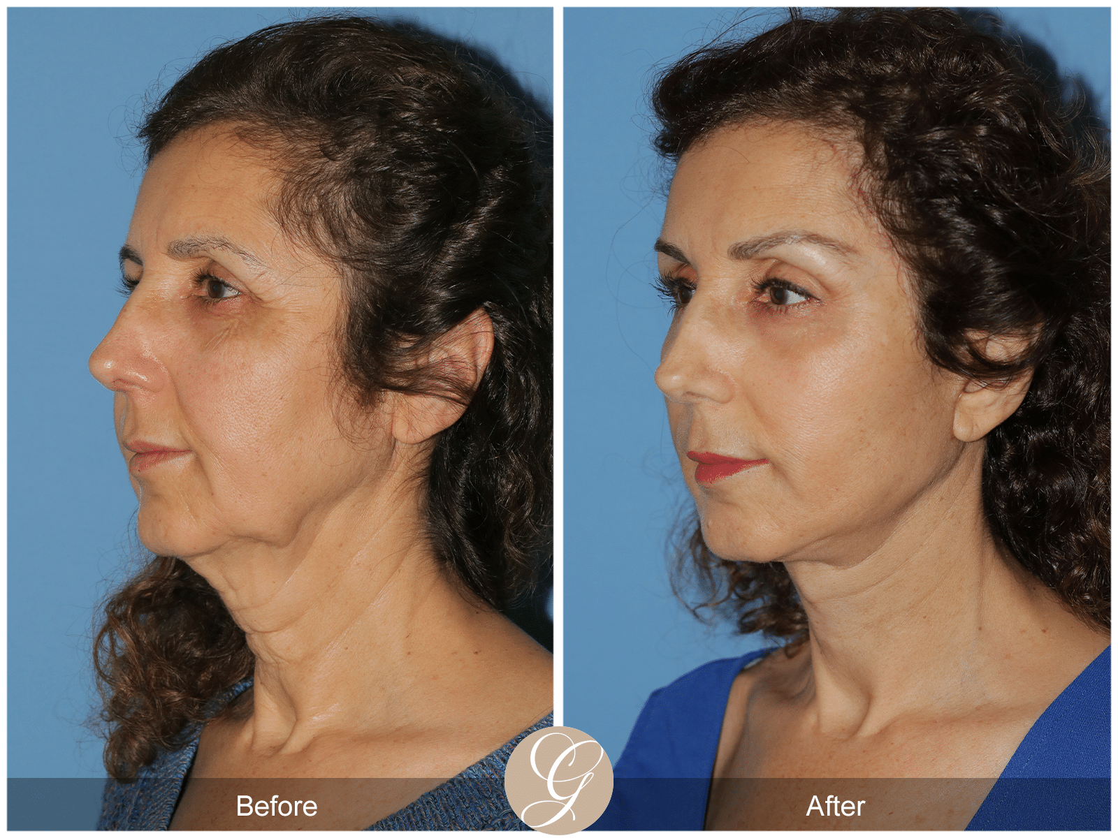 Vertical Facelift Case 3 Before After Photos Orange County