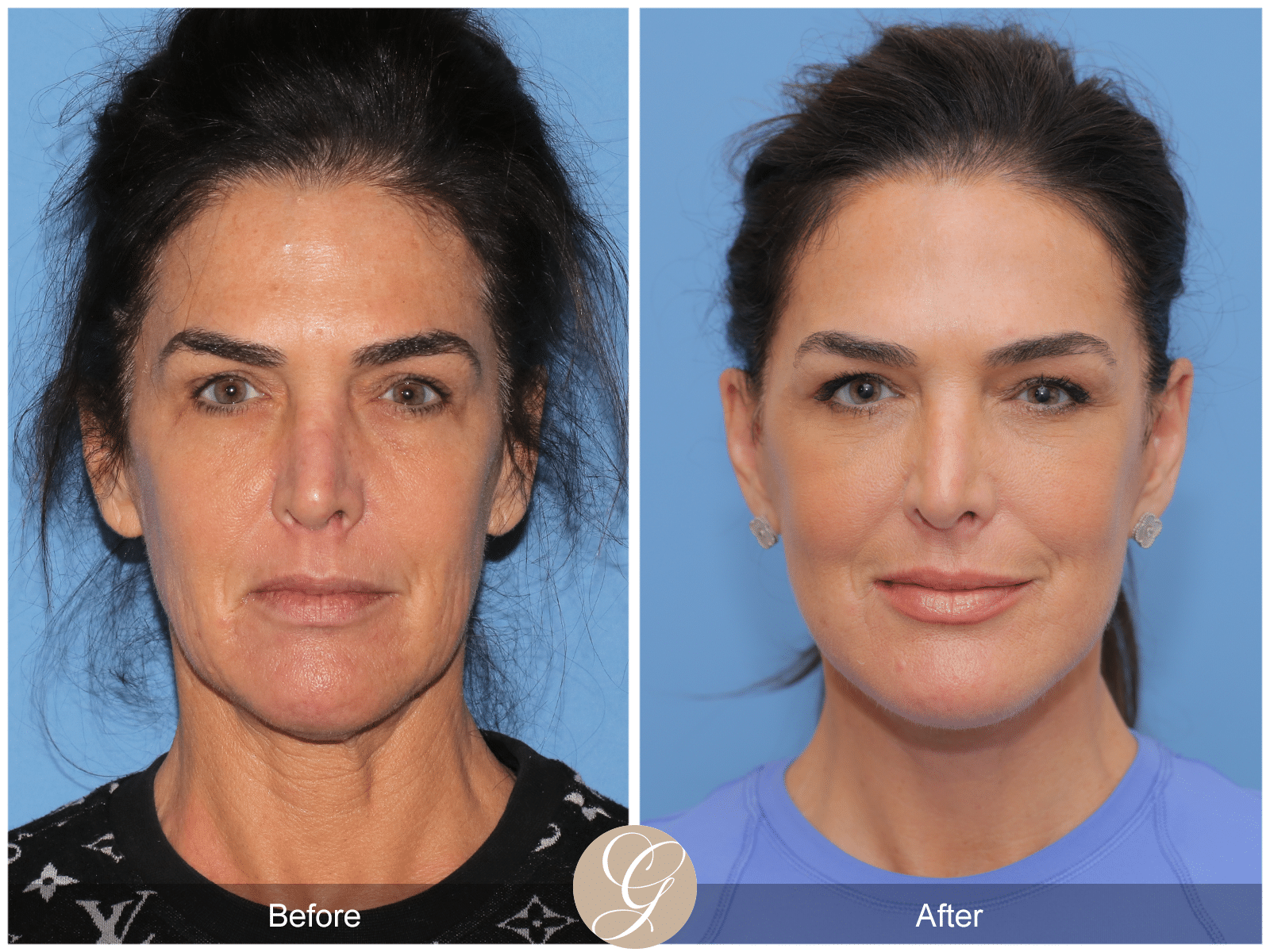 Preservation Facelift Case 1 Before After Photos Orange County