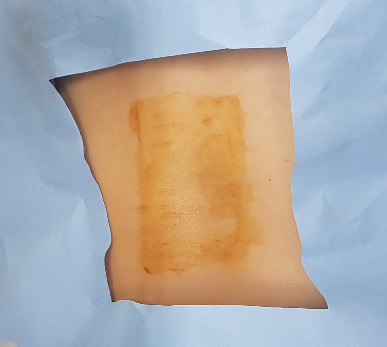 GANA PATCHKFDA approved (bed sore and burn dressing