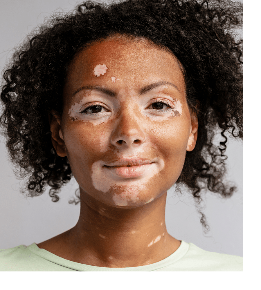 Skin Color Disorders Ann Arbor, MI Ganger Dermatology