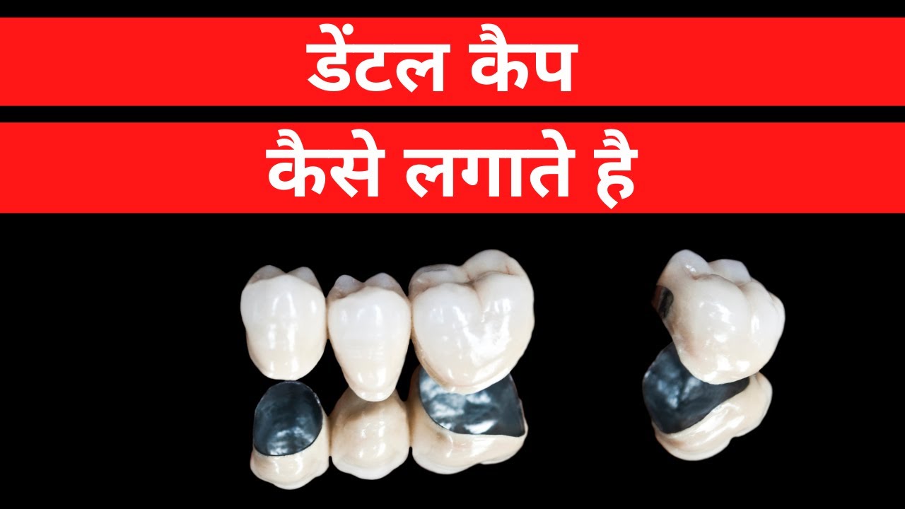 Dental Zirconia Ceramic Cap Fixing 5 steps procedure