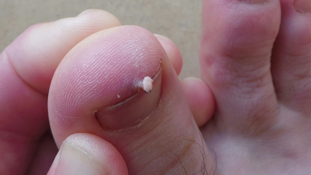 Not For the Squeamish Update on Sam