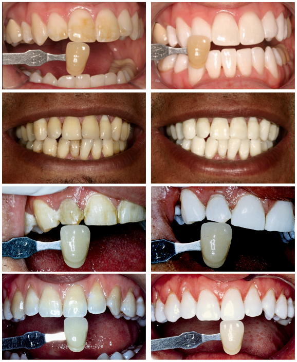 Kor Whitening Carmel, IN Dentist 3175810000