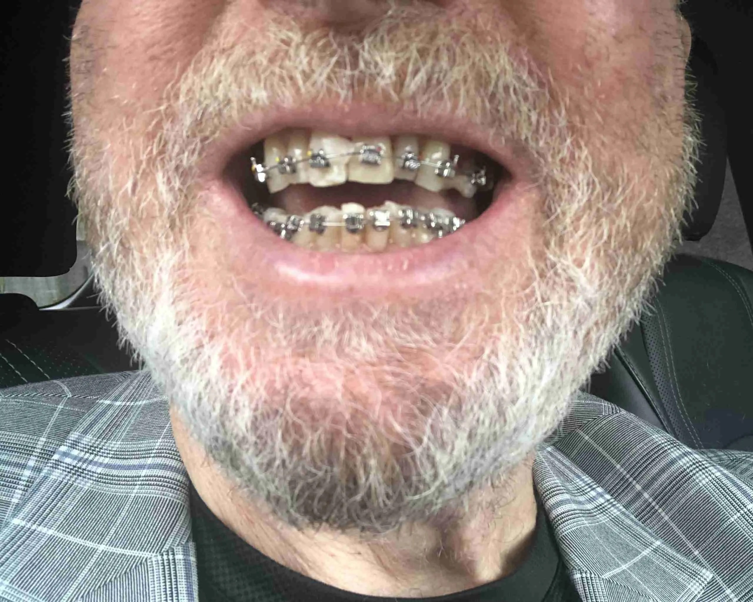 The Ordeal of Getting Teeth Braces at 70 Gary Collier’s Universe