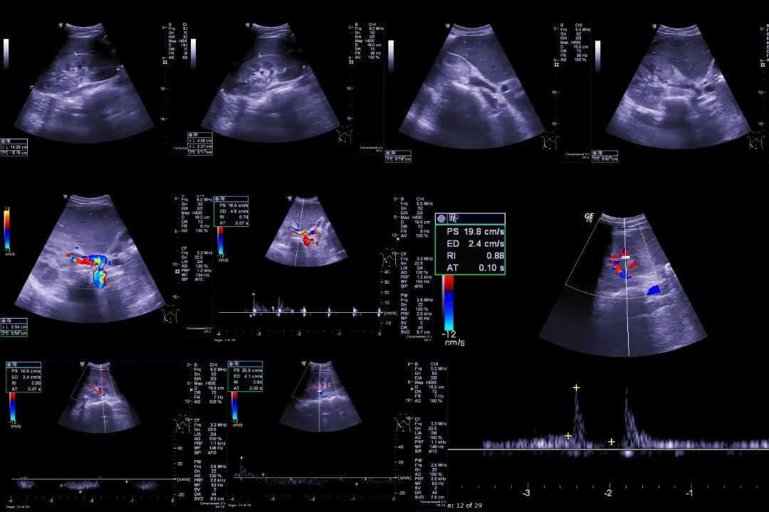 Ultrasound Hepatobiliary System Gastrohealth Clinic Dr Bhavesh