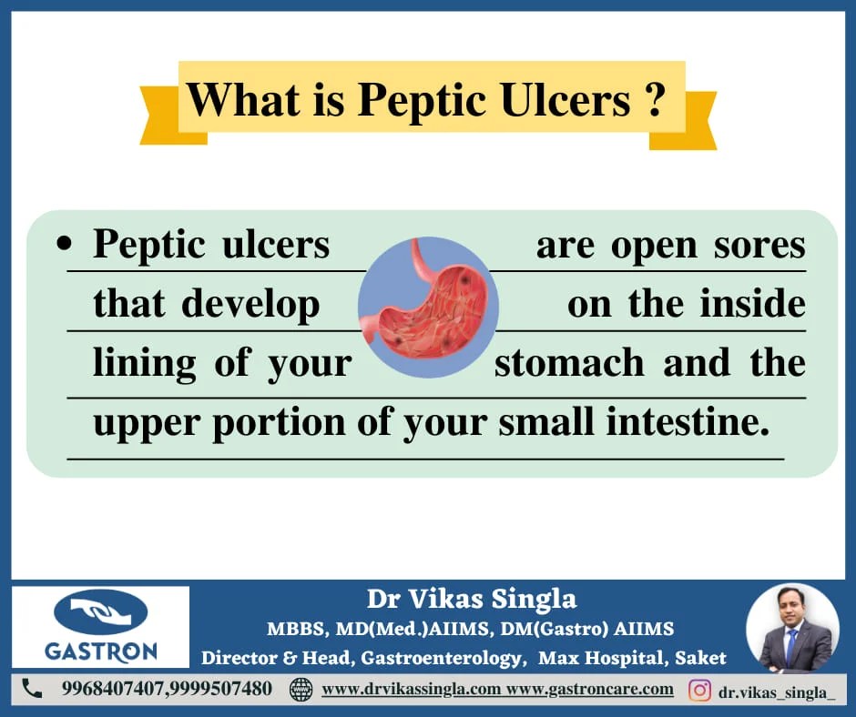 About Peptic Ulcers Gastron