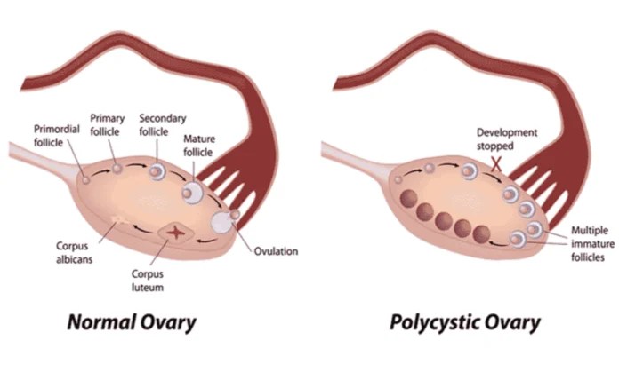 The Best Supplements for Polycystic Ovary Syndrome (PCOS) Gazette Review