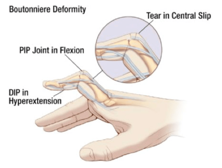 Central Slip Injuries Conservative Management GC Hand Therapy