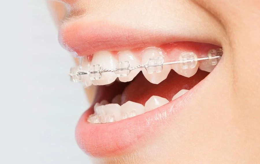 Braces in Doha Qatar German Dental & Dermatology Best braces