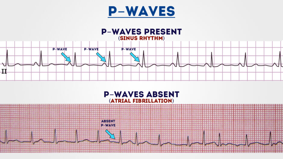 How to Read an ECG ECG Interpretation EKG Geeky Medics