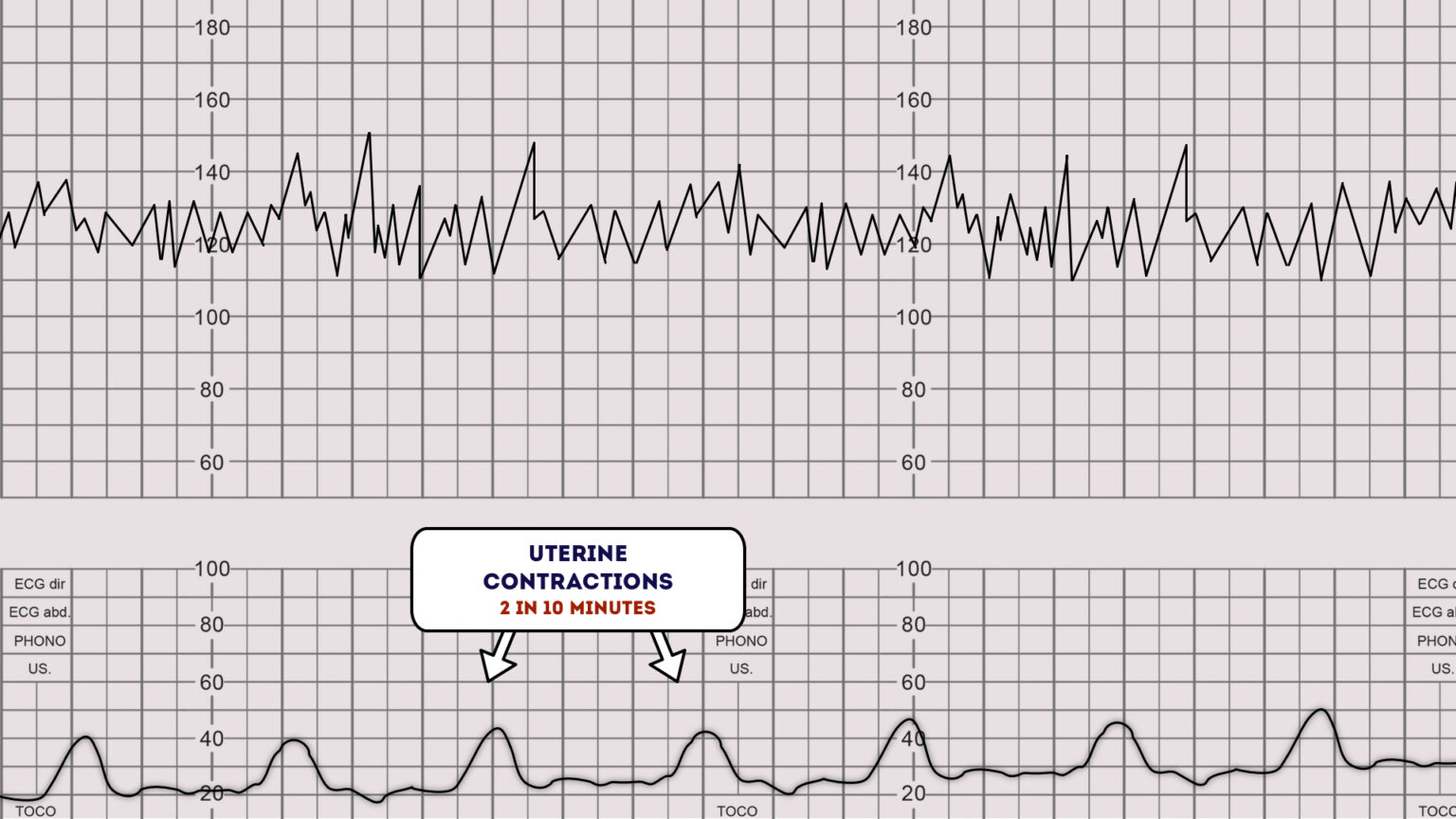 How to Read a CTG CTG Interpretation Geeky Medics