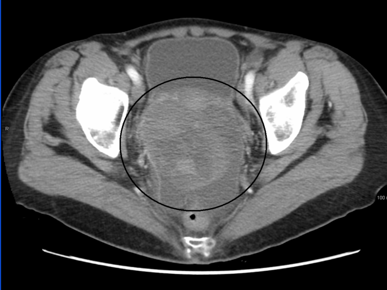 Ovarian Cancer Geeky Medics