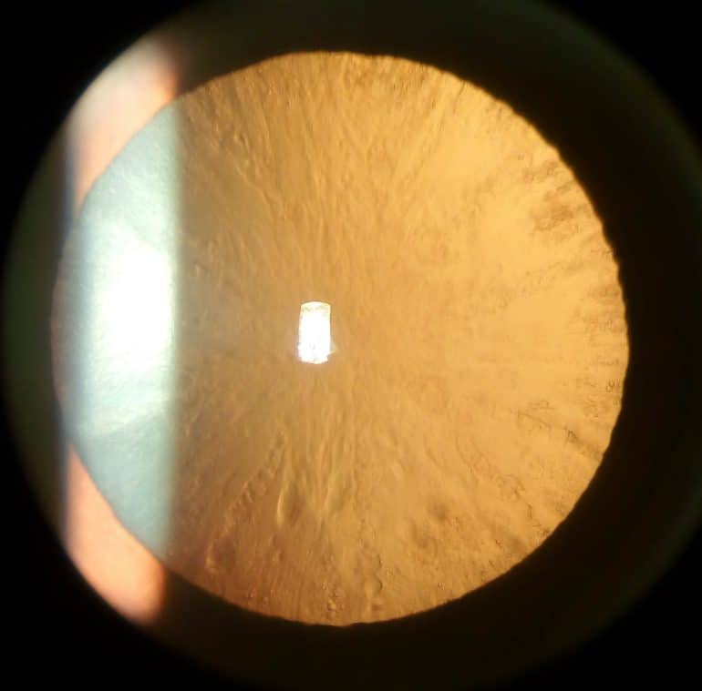Cataracts Ophthalmology Geeky Medics